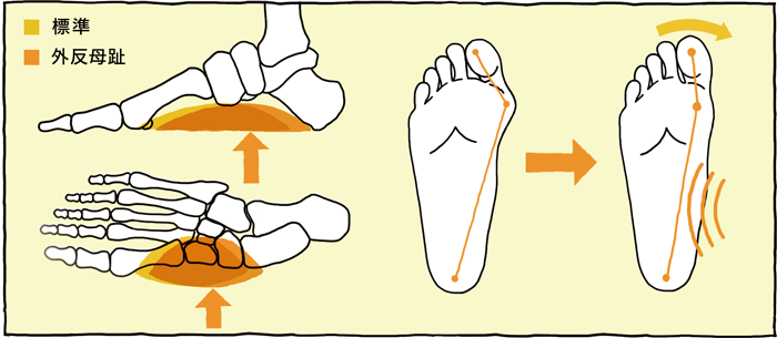 標準と外反母趾の図