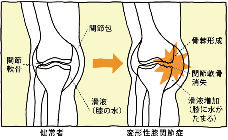 健常者と変形性膝関節症