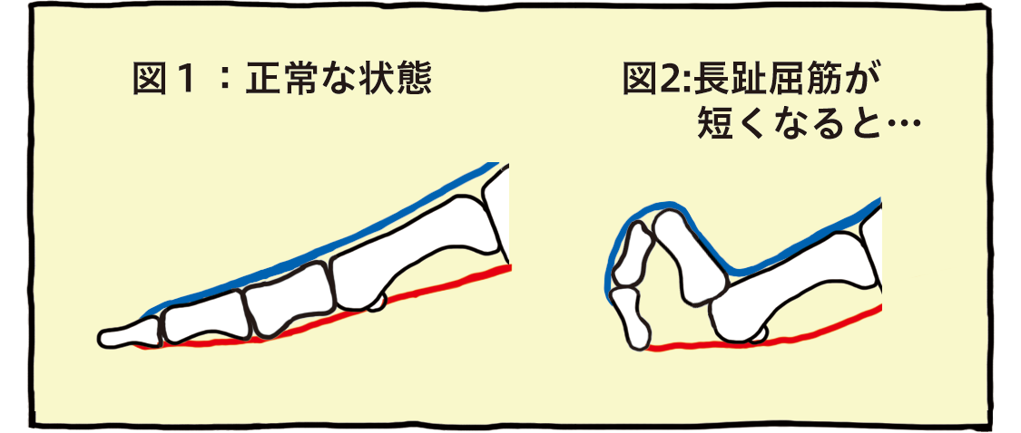 図1：正常な状態　図2：長趾屈筋が短くなると…