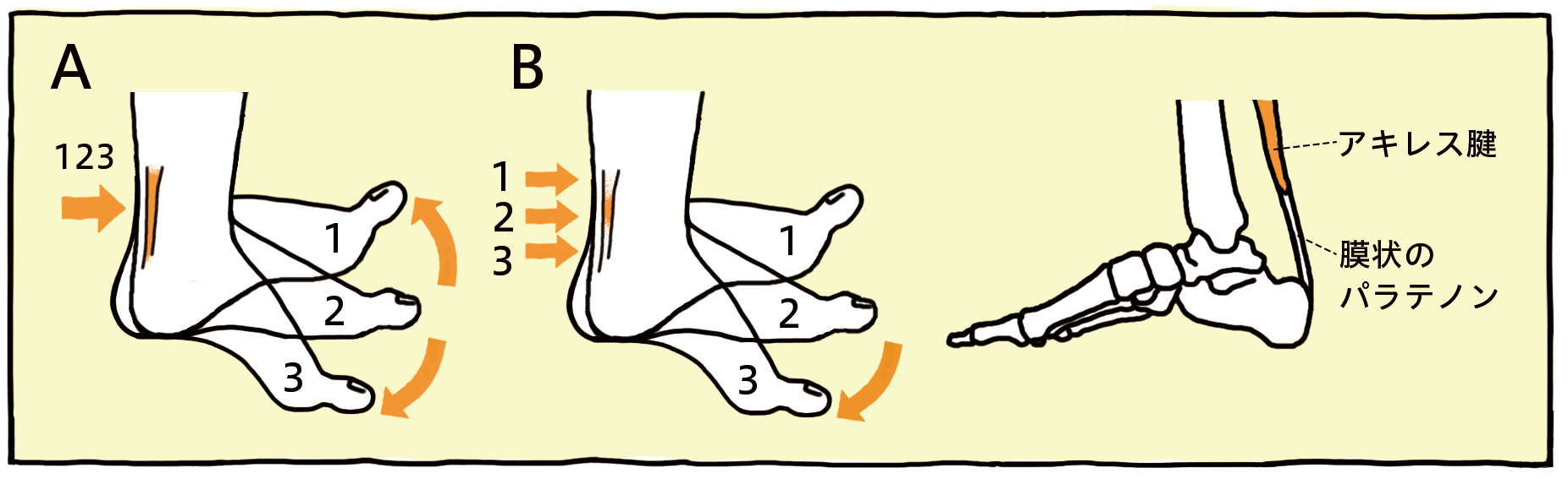 アキレス腱周囲炎のA図とB図