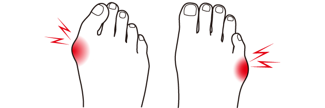 外反母趾・内反小趾