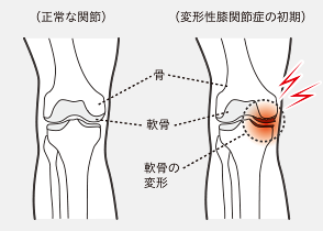 膝痛 変形性膝関節症 におすすめの靴 Akaishi 公式通販