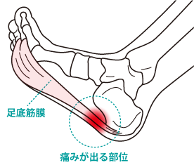 足底筋膜 痛みが出る部位
